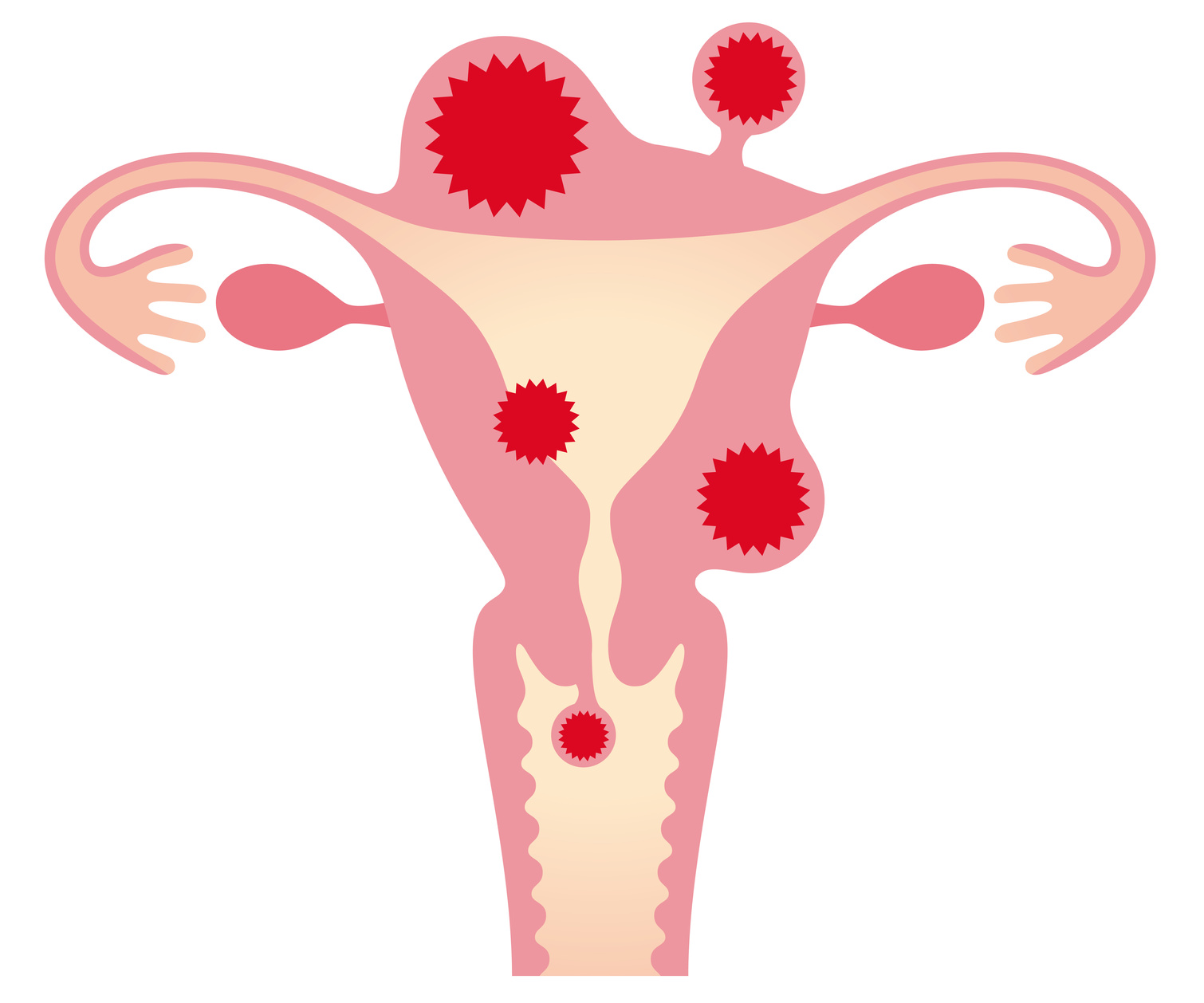子宮筋腫は良性腫瘍とはいえ、早期発見が重要