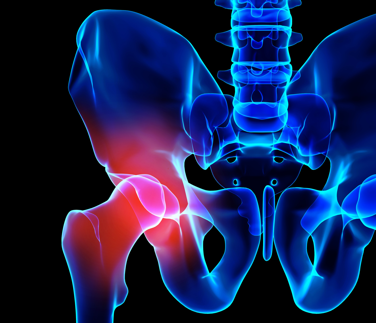 変形性股関節症で股関節が痛い人は名医の人工股関節置換術をうけて、痛みとサヨナラ！